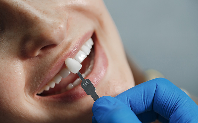 Ultra Aesthetic Veneers